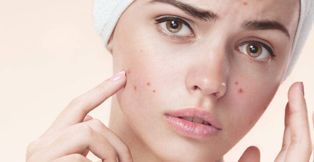 Get rid of acne (home remedy)- मुहांसो से पाएं छुटकारा (घरेलू उपाय)