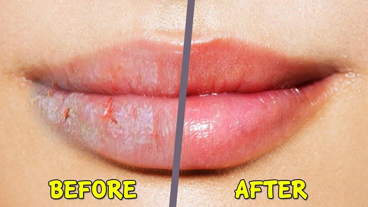 Home remedy for chapped lips- फटे होंठों का करें घरेलू इलाज